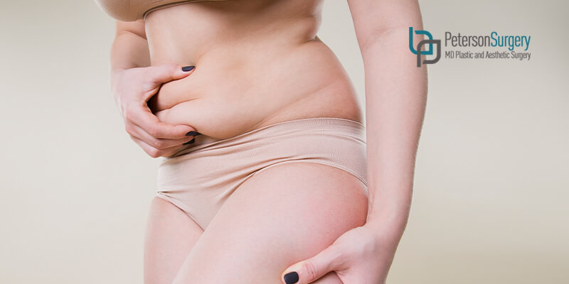 Peterson MD - Blog - Tummy tuck or liposuction